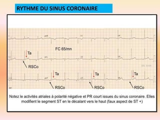 RYTHME DU SINUS CORONAIRE

 