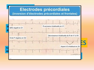 Etalonnage
Positions des électrodes

Inversion des
électrodes
Onde T négative V1 D3 aVR

BETISES
Tracé plat !! Sur une
dérivation !!
Bloc de branche en une seule dérivation !!
BBG + BBD !!

 