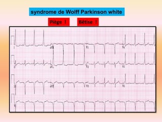 syndrome de Wolff Parkinson white
Piège !

Bêtise !

 