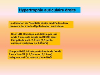 Hypertrophie auriculaire droite

La dilatation de l'oreillette droite modifie les deux
premiers tiers de la dépolarisation auriculaire
Une HAD électrique est définie par une
onde P sinusale ample en DII-DIII dont
l’amplitude est > 2,5 mm (2,5 petits
carreaux verticaux ou 0,25 mV)
Une positivité initiale proéminente de l’onde
P en V1 ou V2 (≥ 1,5 mm ou 0,15 mV)
indique aussi l’existence d’une HAD.

 