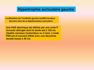 Hypertrophie auriculaire gauche
La dilatation de l'oreillette gauche modifie les deux
derniers tiers de la dépolarisation auriculaire
Une HAG électrique est définie par une onde P
sinusale allongée dont la durée est ≥ 120 ms
(3petits carreaux horizontaux ou 3 mm). L’onde
PDII est et souvent bifide avec une deuxième
double bosse ≥ 40 ms

 