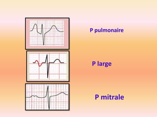 P pulmonaire

P large

P mitrale

 