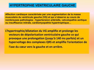 HYPERTROPHIE VENTRICULAIRE GAUCHE
Affection cardiaque caractérisée par une augmentation de la masse
musculaire du ventricule gauche (VG) et qui s’observe au cours de
nombreuses pathologies : hypertension artérielle, valvulopathie aortique
ou insuffisance mitrale, cardiomyopathie hypertrophique…

L’hypertrophie/dilatation du VG amplifie et prolonge les
vecteurs de dépolarisation ventriculaire gauche ce qui
provoque une prolongation (jusqu'à 140 ms parfois) et un
hypervoltage des complexes QRS et amplifie l’orientation de
l’axe du cœur vers la gauche et en arrière.

 