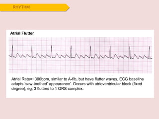 ecg for noob ecg interpretation ecg recall | PPT