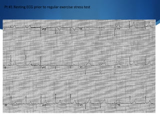 Pt #1 Resting ECG prior to regular exercise stress test
 