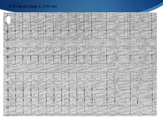 Pt #1 Bruce Stage 1, 2:45 min
 