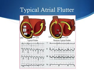 Typical Atrial Flutter
 