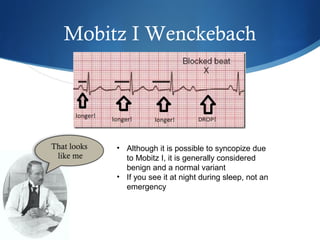 Mobitz I Wenckebach
• Although it is possible to syncopize due
to Mobitz I, it is generally considered
benign and a normal variant
• If you see it at night during sleep, not an
emergency
 