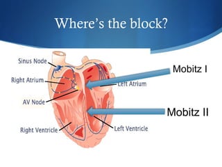 Where’s the block?
Mobitz I
Mobitz II
 