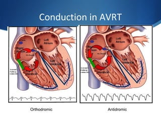 Conduction in AVRT
Orthodromic Antidromic
 