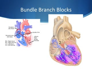 Bundle Branch Blocks
 