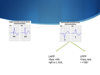 LAFP
•Axis >45o
•qR in I, AVL
LPFP
•Very rare
• >100o
 