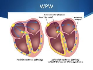 WPW
 