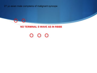 27 yo asian male complains of malignant syncope
NO TERMINAL S WAVE AS IN RBBB
 