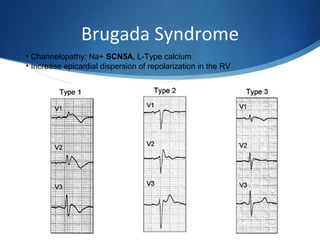 Brugada Syndrome
• Channelopathy: Na+ SCN5A, L-Type calcium
• Increase epicardial dispersion of repolarization in the RV
 