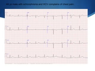 44 yo male with schizophrenia and HCV complains of chest pain:
 