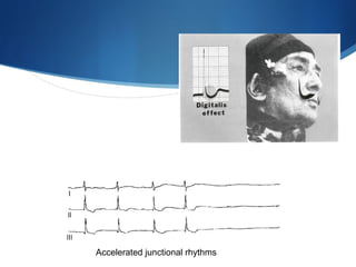 Accelerated junctional rhythms
 