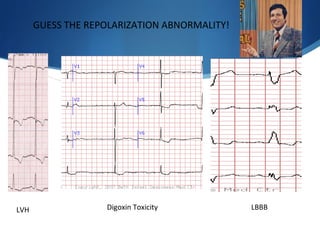 Digoxin Toxicity LBBBLVH
GUESS THE REPOLARIZATION ABNORMALITY!
 