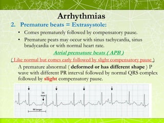 Arrhythmias
Ventricular premature beats ( VPB )
N.B.
When a VPB occurs regularly after each normal beat
Ventricular bigemi...