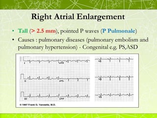 Right Atrial Enlargement
• Tall (> 2.5 mm), pointed P waves (P Pulmonale)
• Causes : pulmonary diseases (pulmonary embolis...