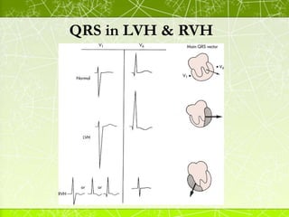 QRS Complexes
 B) Interval (duration):
The width of the QRS complex should be less than 3 small squares
(0.12 seconds )
W...