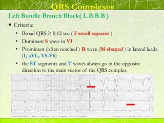 QRS Complexes
Left Bundle Branch Block( L.B.B.B )
 Causes :
( Aortic stenosis, Ischaemic heart disease, Hypertension, Dil...