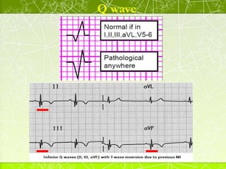 Poor R Wave Progression
• R wave height ≤ 3 mm ( 3 small squares ) in V3.
• The R wave height normally becomes progressive...