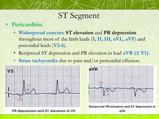 ST Segment
Pericarditis
elevation reciprocal ST depression
 