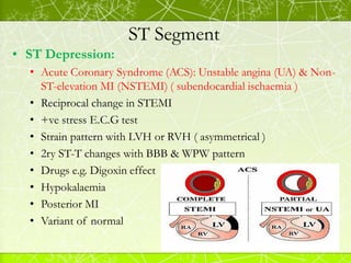 ST Segment
• Subendocardial ischaemia:
• ST depression is usually widespread — typically present in leads
I, II, V4-6 and ...