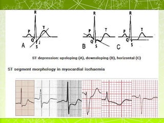 ST Segment
• Digoxin Effect:
• Down-sloping ST depression with a characteristic “sagging”
appearance (see below).
• Flatte...