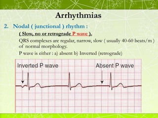 Arrhythmias
Mobitz type II HB :
 Intermittent non-conducted P waves without progressive
prolongation of the PR interval (...