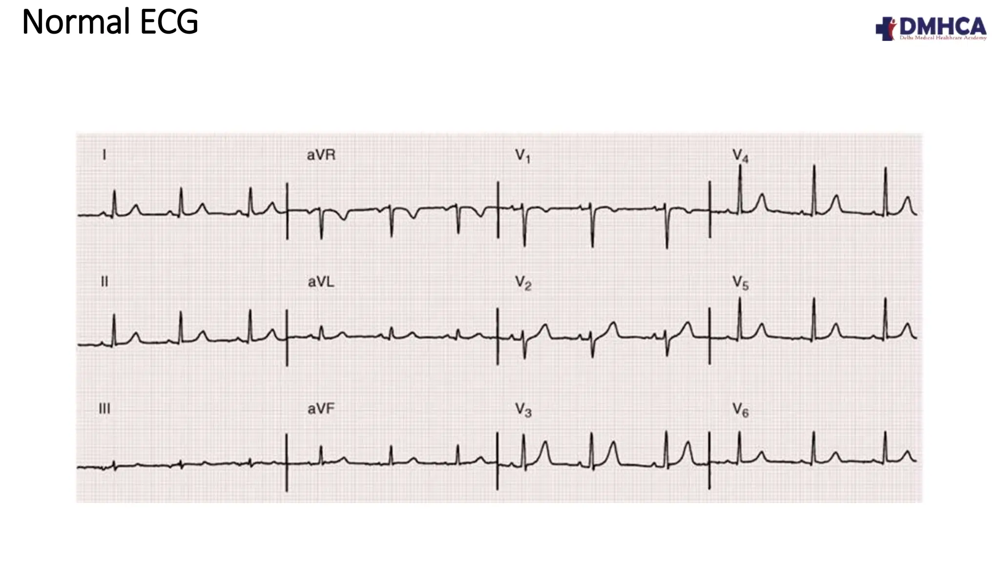 ECG Fundamentals.pptx