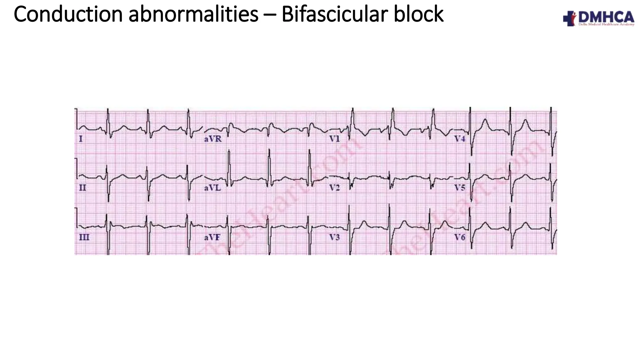 ECG Fundamentals pptx ecg-fundamentals-pptx