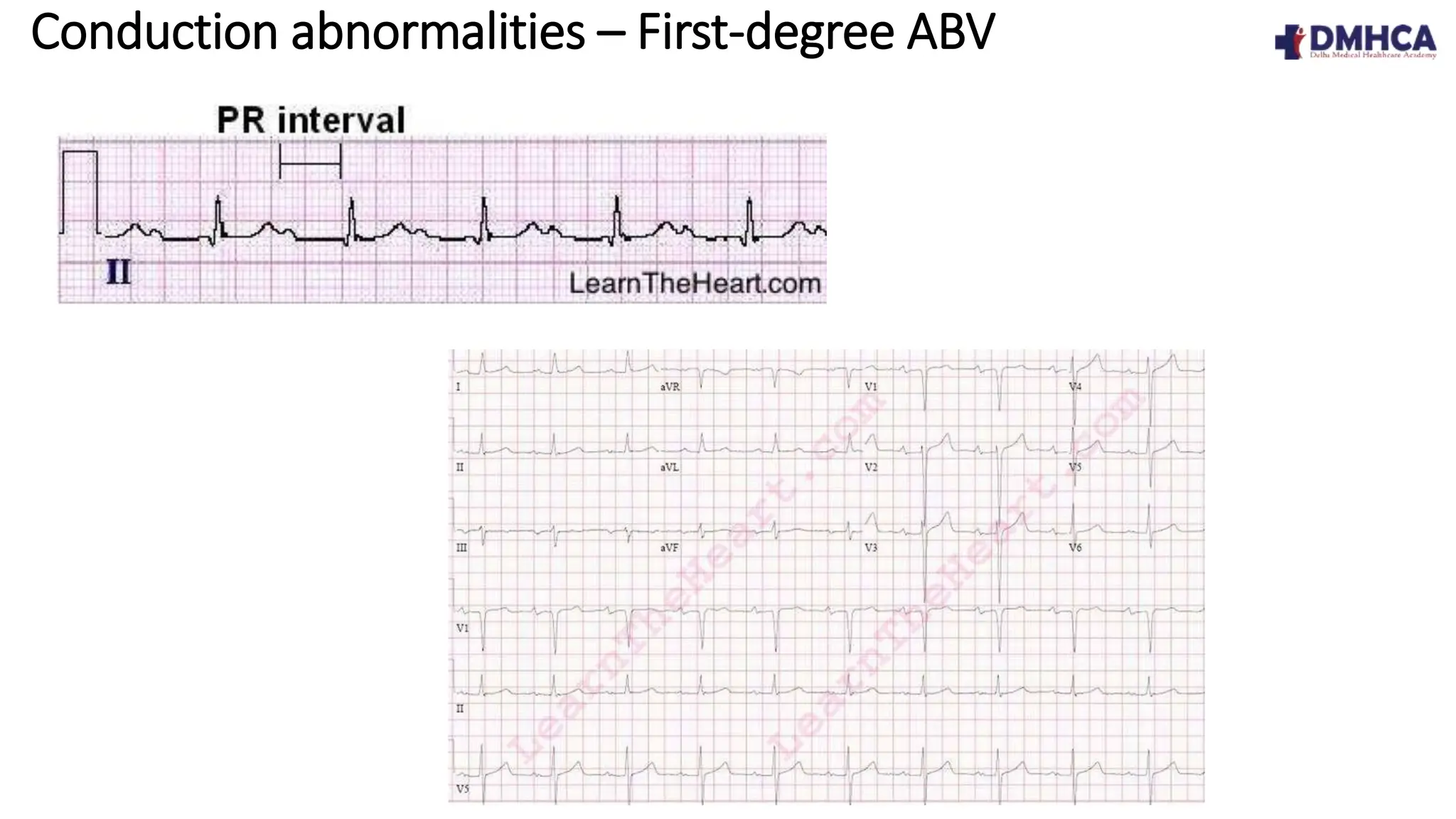 ECG Fundamentals.pptx