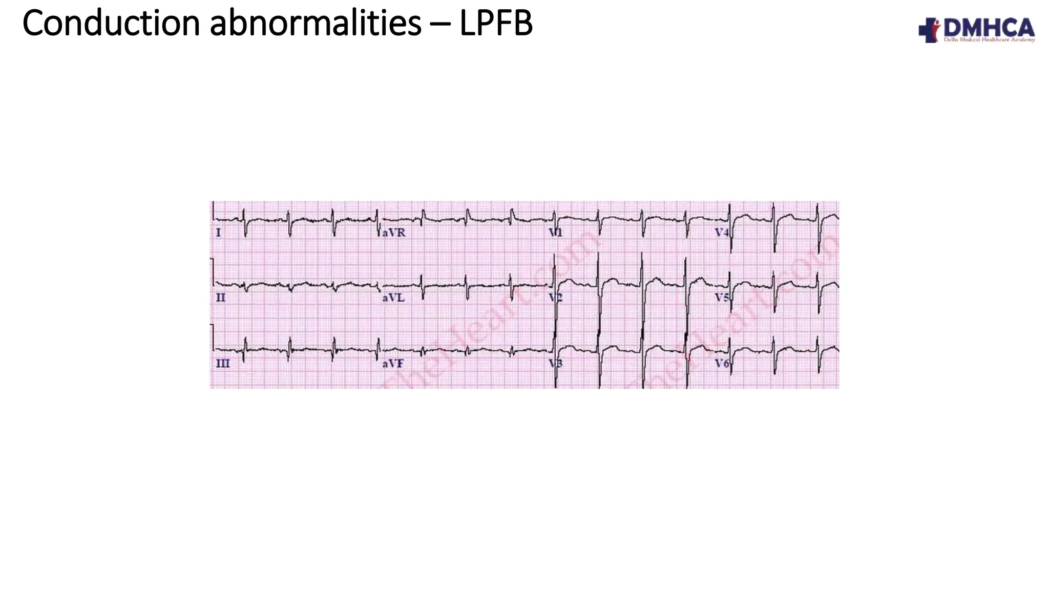 ECG Fundamentals.pptx