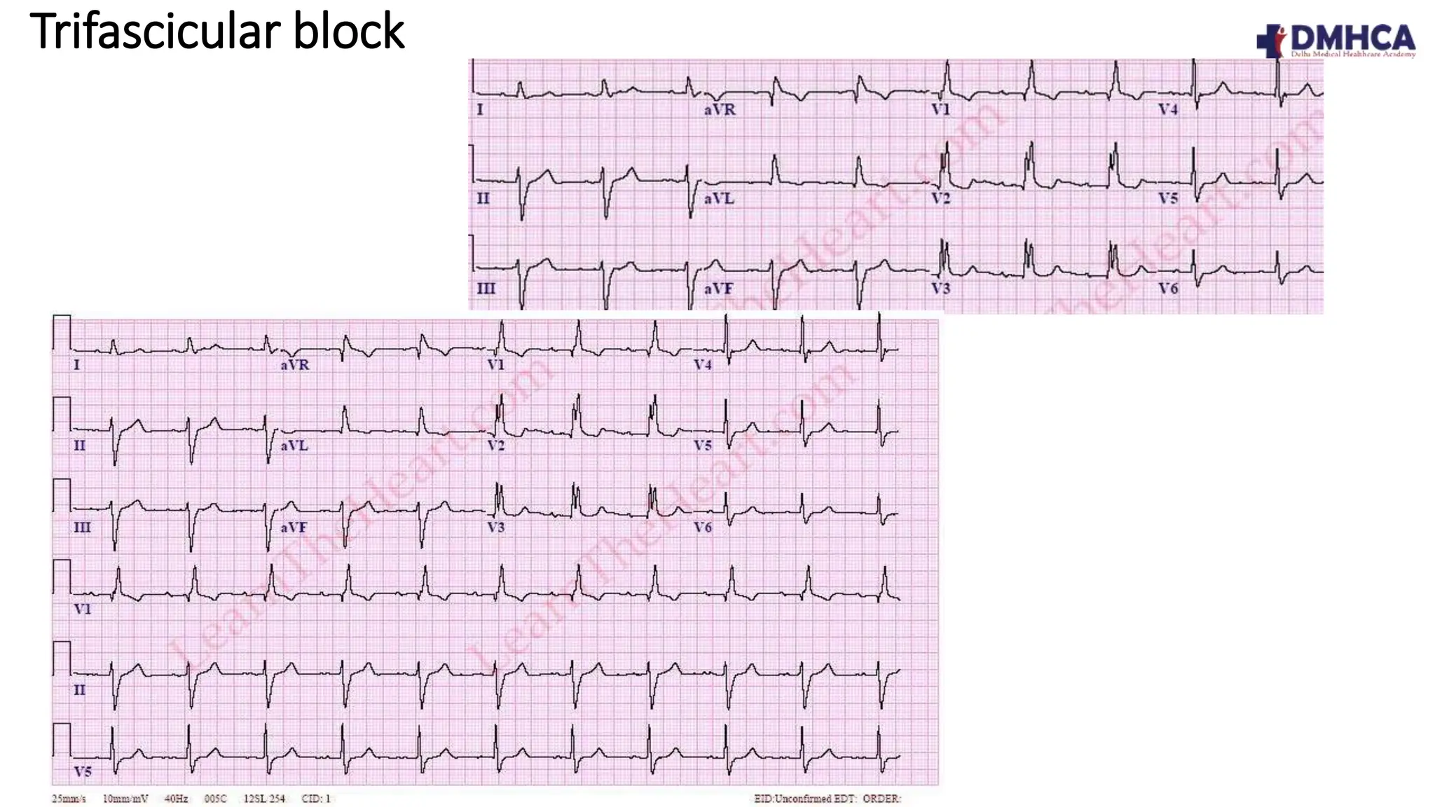 ECG Fundamentals.pptx