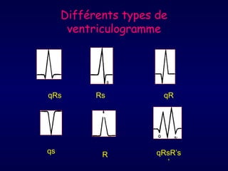 Différents types de
ventriculogramme

qRs

qs

Rs

R

qR

qRsR’s
’

 