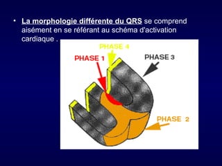 • La morphologie différente du QRS se comprend
  aisément en se référant au schéma d'activation
  cardiaque .
 