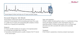 Second-degree SA block
Second-degree sinoatrial block denotes the intermittent failure of
conduction of sinus impulses to the surrounding atrial tissue.This is seen
as a sudden loss of P waves and corresponding QRS complexes. SA block
usually occurs irregularly and unpredictably.
Diagnosis
•	 P waves and QRS complexes do not appear in the expected position
•	 An escape beat may appear later in the cycle
•	 The duration of the block period is usually a multiple of the P-P interval
of the normal rhythm
Signs and symptoms
SA block is seldom clinically significant unless it is a manifestation of drug
toxicity with digitalis, quinidine or other antiarrhythmic drugs. It is
especially prevalent in athletes and youngsters with an increased vagal
tone and is also often associated with uraemia and occasionally
hyperaemia.
Treatment
If the SA block is symptomatic, intravenous atropine may be given.
Second-degree SA block with drop-out of P waves and QRS complex.
 