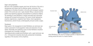 29
Signs and symptoms
Because of the completely irregular atrial rate, the function of the atria is
disorganised and chaotic with no effective systolic contraction.This
predisposes to thrombus formation in the atria and consequent systemic
emboli. If the ventricular rate is rapid, diastolic filling is reduced and the
patient may experience dyspnoea and peripheral or pulmonary oedema.
The aetiology of atrial fibrillation is closely associated with myocardial
damage and increased atrial pressure.The causes include hypoxaemia,
anaemia, hypertension, congestive heart failure, mitral regurgitation,
thyrotoxicosis, alcohol misuse, cardiomyopathy and post-cardiac surgery.
Treatment
Major goals in the management of atrial fibrillation are ventricular rate
control, assessment of anticoagulation needs and restoration of sinus
rhythm. Reversible and underlying causes of atrial fibrillation should be
investigated and, if possible, corrected.
Haemodynamically unstable atrial fibrillation with a rapid ventricular rate
of (> 120 beats/min) should be electrically cardioverted immediately,
regardless of the duration of the arrhythmia.
Sinoatrial node
Atrioventricular
node
Right atrium
Left atrium
Atrial fibrillation is the result of multiple wavelets of depolarisation
moving around the atria in a chaotic fashion.
 