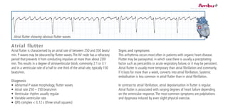 Atrial flutter
Atrial flutter is characterised by an atrial rate of between 250 and 350 beats/
min. P waves may be obscured by flutter waves.The AV node has a refractory
period that prevents it from conducting impulses at more than about 230/
min.This results in a degree of atrioventricular block, commonly 2:1 or 3:1
and in a ventricular rate of a half or one third of the atrial rate, typically 150
beats/min.
Diagnosis
•	 Abnormal P wave morphology, flutter waves
•	 Atrial rate 250 – 350 beats/min
•	 Ventricular rhythm usually regular
•	 Variable ventricular rate
•	 QRS complex < 0.12 s (three small squares)
Signs and symptoms
This arrhythmia occurs most often in patients with organic heart disease.
Flutter may be paroxysmal, in which case there is usually a precipitating
factor such as pericarditis or acute respiratory failure, or it may be persistent.
Atrial flutter is usually more temporary than atrial fibrillation and commonly,
if it lasts for more than a week, converts into atrial fibrillation. Systemic
embolisation is less common in atrial flutter than in atrial fibrillation.
In contrast to atrial fibrillation, atrial depolarisation in flutter is regular.
Atrial flutter is associated with varying degrees of heart failure depending
on the ventricular response.The most common symptoms are palpitations
and dyspnoea induced by even slight physical exercise.
Atrial flutter showing obvious flutter waves.
 
