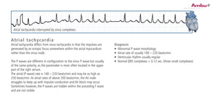 Atrial tachycardia
Atrial tachycardia differs from sinus tachycardia in that the impulses are
generated by an ectopic focus somewhere within the atrial myocardium
rather than the sinus node.
The P waves are different in configuration to the sinus P wave but usually
of the same polarity, as the pacemaker is most often located in the upper
part of the right atrium.
The atrial (P wave) rate is 140 – 220 beats/min and may be as high as
250 beats/min.At atrial rates of above 200 beats/min, the AV node
struggles to keep up with impulse conduction and AV block may occur.
Sometimes however, the P waves are hidden within the preceding T wave
and are not visible.
Diagnosis
•	 Abnormal P wave morphology
•	 Atrial rate of usually 140 – 220 beats/min
•	 Ventricular rhythm usually regular
•	 Normal QRS complexes < 0.12 sec. (three small complexes)
Atrial tachycardia interrupted by sinus complexes.
 
