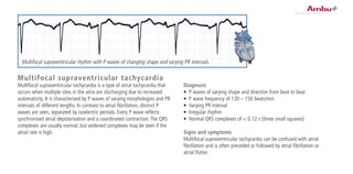 Multifocal supraventricular tachycardia
Multifocal supraventricular tachycardia is a type of atrial tachycardia that
occurs when multiple sites in the atria are discharging due to increased
automaticity. It is characterised by P waves of varying morphologies and PR
intervals of different lengths. In contrast to atrial fibrillation, distinct P
waves are seen, separated by isoelectric periods. Every P wave reflects
synchronised atrial depolarisation and a coordinated contraction.The QRS
complexes are usually normal, but widened complexes may be seen if the
atrial rate is high.
Diagnosis
•	 P waves of varying shape and direction from beat to beat
•	 P wave frequency of 120 – 150 beats/min	
•	 Varying PR interval
•	 Irregular rhythm
•	 Normal QRS complexes of < 0.12 s (three small squares)
Signs and symptoms
Multifocal supraventricular tachycardia can be confused with atrial
fibrillation and is often preceded or followed by atrial fibrillation or
atrial flutter.
Multifocal supraventricular rhythm with P waves of changing shape and varying PR intervals.
 