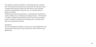37
This relatively uncommon arrhythmia is most frequently seen in patients
with chronic pulmonary disease with cor pulmonale, but may also be seen
in patients with pulmonary emboli, left heart failure, acute myocardial
infarction and hypoxaemia. It may also occur as a terminal feature in
elderly sick patients.
Multifocal supraventricular tachycardia is a bad prognostic sign because it
usually indicates serious underlying heart disease.At rates < 100 beats/min
it is called a multifocal supraventricular rhythm.The ECG picture appears
similar to multifocal supraventricular tachycardia but it is harmless and
does not usually require treatment.
Treatment
Treat the underlying heart disease. In some cases, careful digitalisation may
be warranted, taking note that very ill patients are often sensitive to over
digitalisation.
 