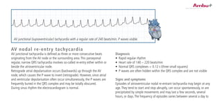 Diagnosis
•	 Rapid regular rhythm
•	 Heart rate of 140 – 220 beats/min
•	 Normal QRS complexes < 0.12 s (three small squares)
•	 P waves are often hidden within the QRS complex and are not visible
Signs and symptoms
Episodes of atrioventricular nodal re-entrant tachycardia may begin at any
age.They tend to start and stop abruptly, can occur spontaneously, or are
precipitated by simple movements and may last a few seconds, several
hours, or days.The frequency of episodes varies between several a day to
AV nodal re-entry tachycardia
AV junctional tachycardia is defined as three or more consecutive beats
originating from the AV node or the surrounding area.This paroxysmal
regular, narrow QRS tachycardia involves so-called re-entry either within or
beside the atrioventricular node.
Retrograde atrial depolarisation occurs (backwards) up through the AV
node, which causes the P wave to invert (retrograde). However, since atrial
and ventricular depolarisation often occur simultaneously, the P waves are
frequently buried in the QRS complex and may be totally obscured.
During sinus rhythm the electrocardiogram is normal.
AV junctional (supraventricular) tachycardia with a regular rate of 240 beats/min. P waves visible.
 