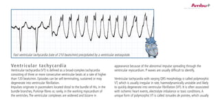 Ventricular tachycardia
Ventricular tachycardia (VT) is defined as a broad-complex tachycardia
consisting of three or more consecutive ventricular beats at a rate of higher
than 120 beats/min. Episodes can be self-terminating, sustained or may
degenerate into ventricular fibrillation.
Impulses originate in pacemakers located distal to the bundle of His, in the
bundle branches, Purkinje fibres or, rarely, in the working myocardium of
the ventricles.The ventricular complexes are widened and bizarre in
appearance because of the abnormal impulse spreading through the
ventricular myocardium. P waves are usually difficult to identify.
Ventricular tachycardia with varying QRS morphology is called polymorphic
VT, which is usually irregular in rate, haemodynamically unstable and likely
to quickly degenerate into ventricular fibrillation (VF). It is often associated
with ischemic heart events, electrolyte imbalance or toxic conditions.A
unique form of polymorphic VT is called torsades de pointes, which usually
Fast ventricular tachycardia (rate of 210 beats/min) precipitated by a ventricular extrasystole.
 
