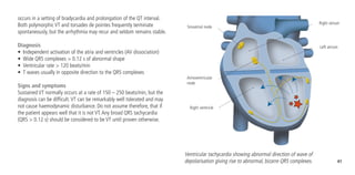 41
occurs in a setting of bradycardia and prolongation of the QT interval.
Both polymorphic VT and torsades de pointes frequently terminate
spontaneously, but the arrhythmia may recur and seldom remains stable.
Diagnosis
•	 Independent activation of the atria and ventricles (AV dissociation)
•	 Wide QRS complexes > 0.12 s of abnormal shape
•	 Ventricular rate > 120 beats/min
•	 T waves usually in opposite direction to the QRS complexes
Signs and symptoms
Sustained VT normally occurs at a rate of 150 – 250 beats/min, but the
diagnosis can be difficult.VT can be remarkably well tolerated and may
not cause haemodynamic disturbance. Do not assume therefore, that if
the patient appears well that it is not VT.Any broad QRS tachycardia
(QRS > 0.12 s) should be considered to be VT until proven otherwise.
Sinoatrial node
Atrioventricular
node
Right atrium
Left atrium
Ventricular tachycardia showing abnormal direction of wave of
depolarisation giving rise to abnormal, bizarre QRS complexes.
Right ventricle
 