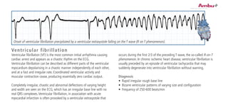 Ventricular fibrillation
Ventricular fibrillation (VF) is the most common initial arrhythmia causing
cardiac arrest and appears as a chaotic rhythm on the ECG.
Ventricular fibrillation can be described as different parts of the ventricular
myocardium depolarising in a chaotic manner independently of each other,
and at a fast and irregular rate. Coordinated ventricular activity and
muscular contraction cease, producing essentially zero cardiac output.
Completely irregular, chaotic and abnormal deflections of varying height
and width are seen on the ECG, which has an irregular base line with no
real QRS complexes.Ventricular fibrillation, in association with acute
myocardial infarction is often provoked by a ventricular extrasystole that
occurs during the first 2/3 of the preceding T wave, the so-called R-on-T
phenomenon. In chronic ischemic heart disease, ventricular fibrillation is
usually preceded by an episode of ventricular tachycardia that may
suddenly degenerate into ventricular fibrillation without warning.
Diagnosis
•	 Rapid irregular rough base line
•	 Bizarre ventricular patterns of varying size and configuration
•	 Frequency of 250-600 beats/min
Onset of ventricular fibrillation precipitated by a ventricular extrasystole falling on the T wave (R on T phenomenon).
 
