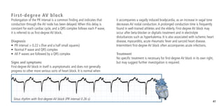 47
First-degree AV block
Prolongation of the PR interval is a common finding and indicates that
conduction through the AV node has been delayed.When this delay is
constant for each cardiac cycle, and a QRS complex follows each P wave,
it is referred to as first-degree AV block.
Diagnosis
•	 PR interval > 0.22 s (five and a half small squares)
•	 Normal P wave and QRS complex
•	 All P waves are followed by a QRS complex
Signs and symptoms
First-degree AV block in itself is asymptomatic and does not generally
progress to other more serious sorts of heart block. It is normal when
it accompanies a vagally induced bradycardia, as an increase in vagal tone
decreases AV nodal conduction.A prolonged conduction time is frequently
found in well-trained athletes and the elderly. First-degree AV block may
occur after beta-blocker or digitalis treatment and in electrolyte
disturbances such as hyperkalemia. It is also associated with ischemic heart
disease, myocarditis, acute rheumatic fever and sarcoid heart disease.
Intermittent first-degree AV block often accompanies acute infections.
Treatment
No specific treatment is necessary for first-degree AV block in its own right,
but may suggest further investigation is required.
Sinus rhythm with first-degree AV block (PR interval 0.26 s).
 