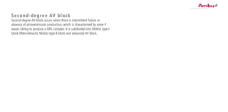 Second-degree AV block
Second-degree AV block occurs when there is intermittent failure or
absence of atrioventricular conduction, which is characterised by some P
waves failing to produce a QRS complex. It is subdivided into Mobitz type I
block (Wenckebach), Mobitz type II block and advanced AV block.
 
